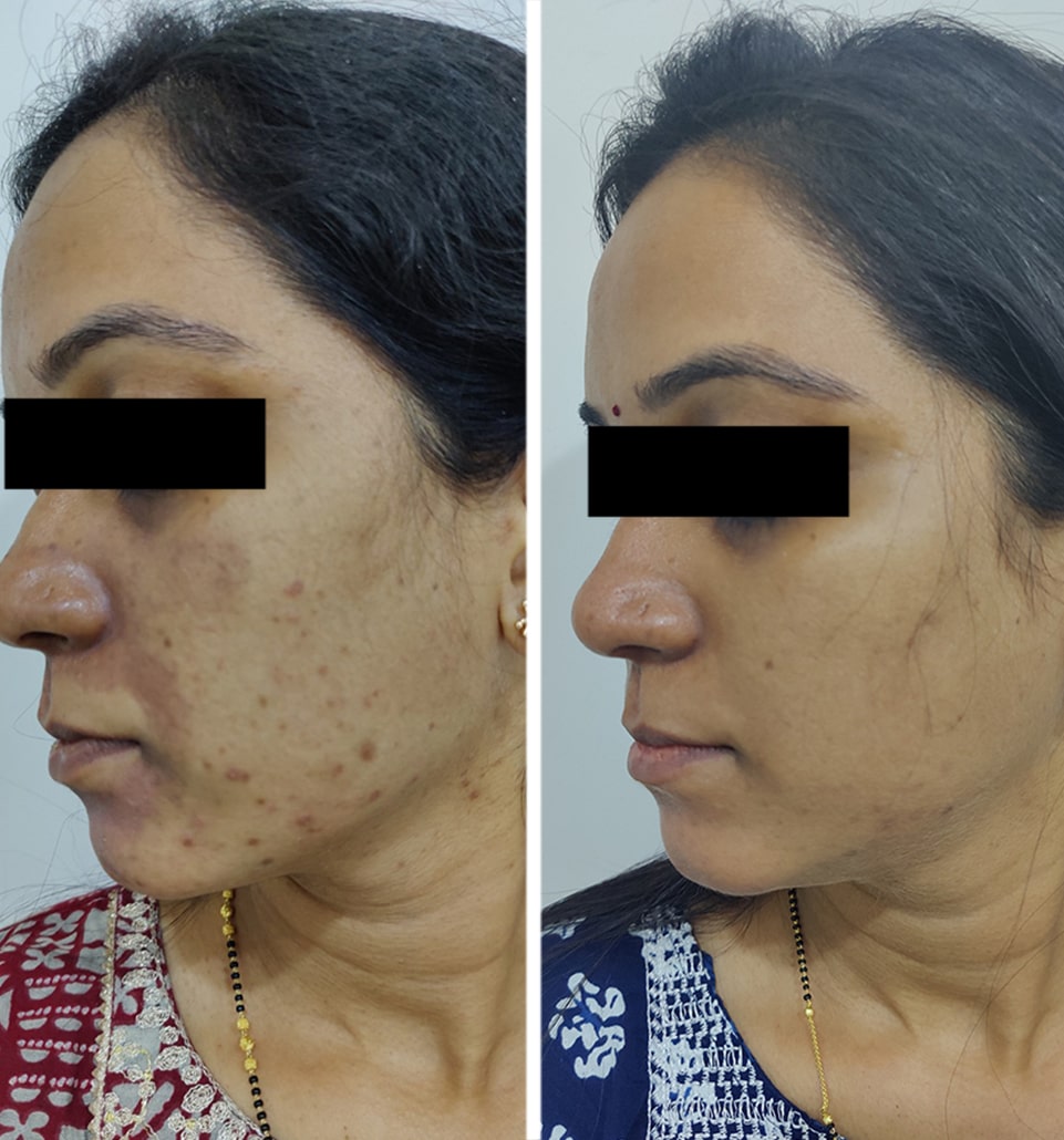 acne-treatment1