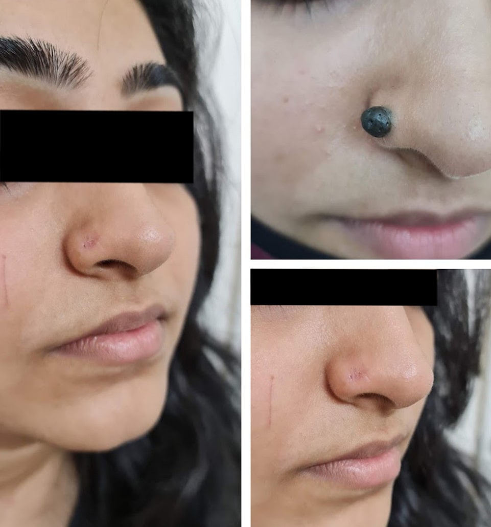 mole-removal-surgery