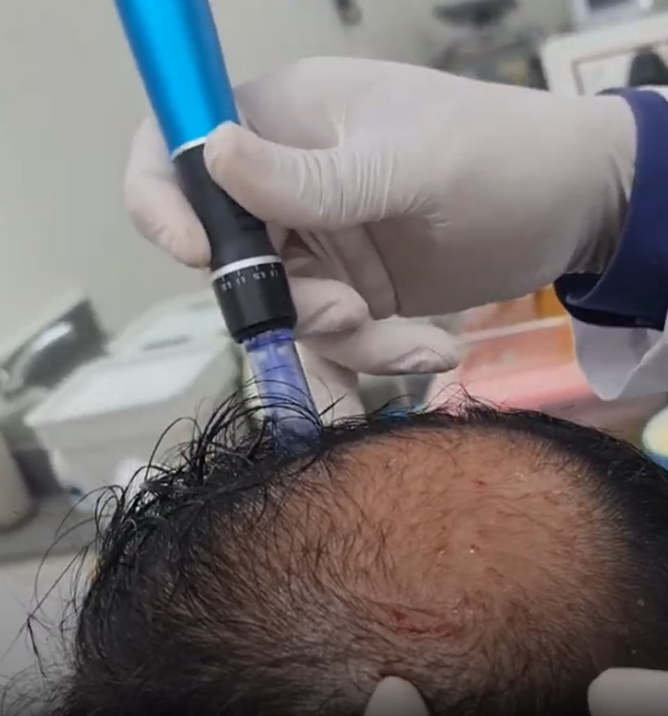 prp-with-microneedling-hair-treatment